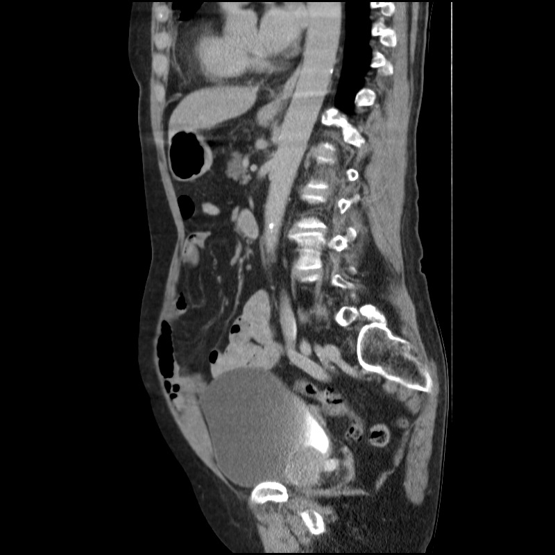 Bladder tumor detected on trauma CT (Radiopaedia 51809-57609 E 31).jpg