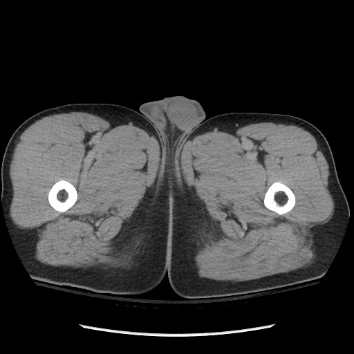 File:Blunt abdominal trauma with solid organ and musculoskelatal injury with active extravasation (Radiopaedia 68364-77895 Axial C+ delayed 161).jpg