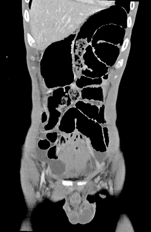 Blunt injury to the small bowel (Radiopaedia 74953-85987 B 23).jpg