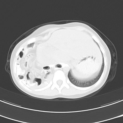 File:Bochdalek diaphragmatic hernia (Radiopaedia 38866-41059 Axial lung window 22).jpg