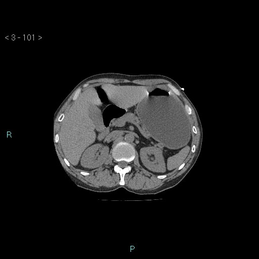 Boerhaave syndrome (Radiopaedia 27683-27897 Axial non-contrast 101).jpg
