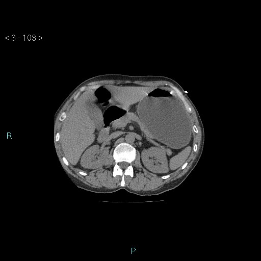 Boerhaave syndrome (Radiopaedia 27683-27897 Axial non-contrast 103).jpg
