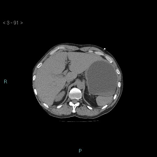 Boerhaave syndrome (Radiopaedia 27683-27897 Axial non-contrast 91).jpg