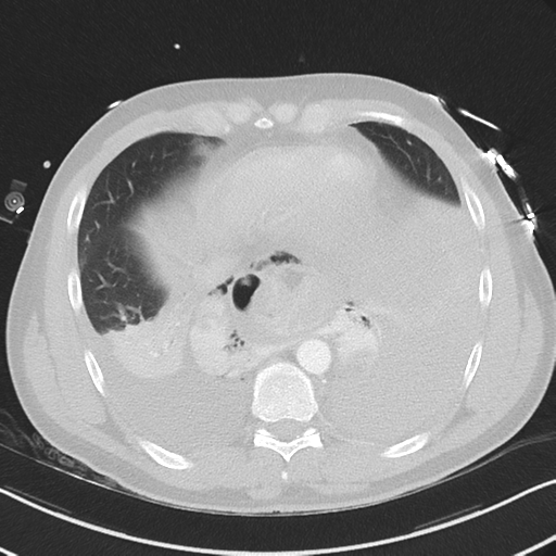 Boerhaave syndrome (Radiopaedia 39382-41661 Axial lung window 42).png