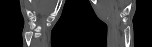 Bone islands - carpus (Radiopaedia 63141-71658 Coronal bone window 55).jpg