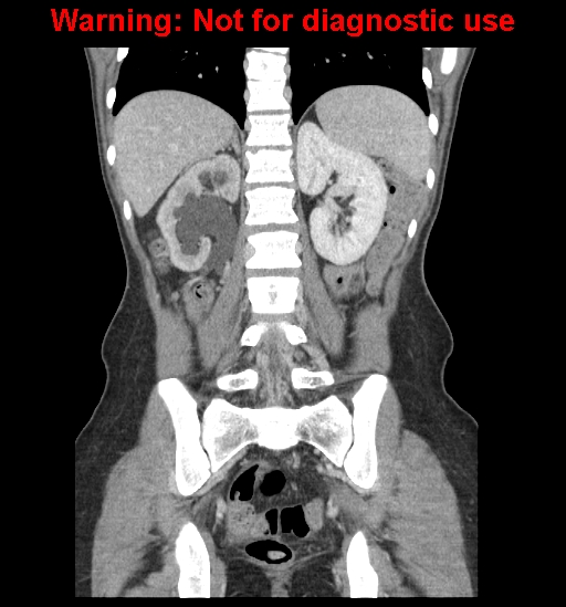 Borderline mucinous cystadenoma of ovary (Radiopaedia 25586-25767 B 47).jpg