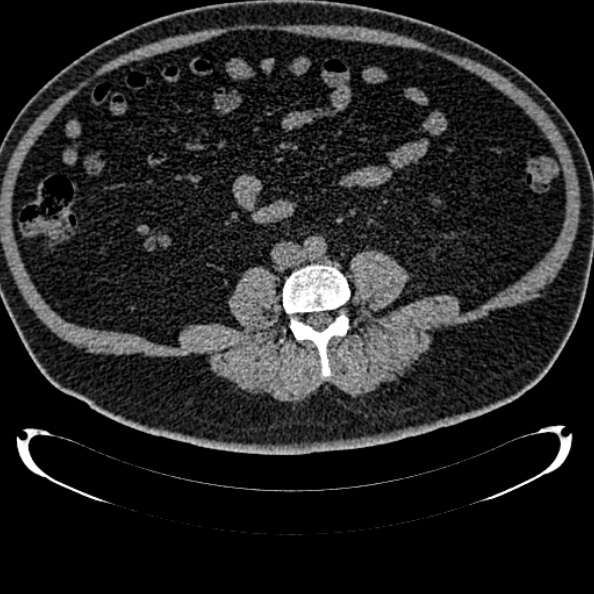 File:Bosniak renal cyst - type IV (Radiopaedia 24244-24518 Axial non-contrast 208).jpg