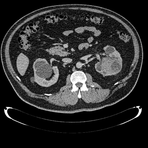 Bosniak renal cyst - type IV (Radiopaedia 24244-24518 C 143).jpg