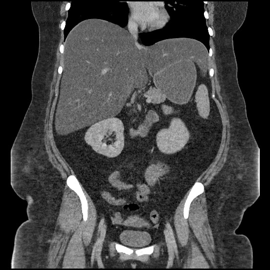 Bowel and splenic infarcts in acute lymphocytic leukemia (Radiopaedia 61055-68913 B 31).jpg