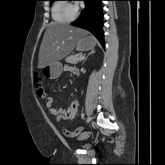 File:Bowel and splenic infarcts in acute lymphocytic leukemia (Radiopaedia 61055-68913 C 36).jpg