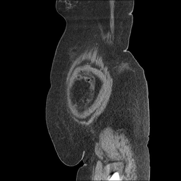 Bowel and splenic infarcts in acute lymphocytic leukemia (Radiopaedia 61055-68915 C 10).jpg