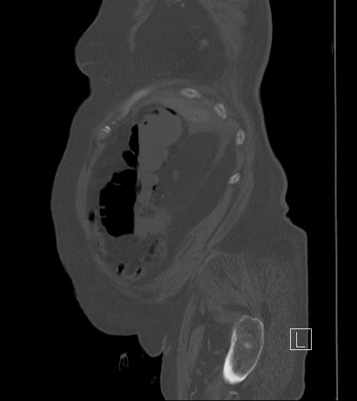 Bowel ischemia secondary to SMA occlusion with extensive portomesenteric venous gas (Radiopaedia 54656-60871 Sagittal bone window 102).jpg