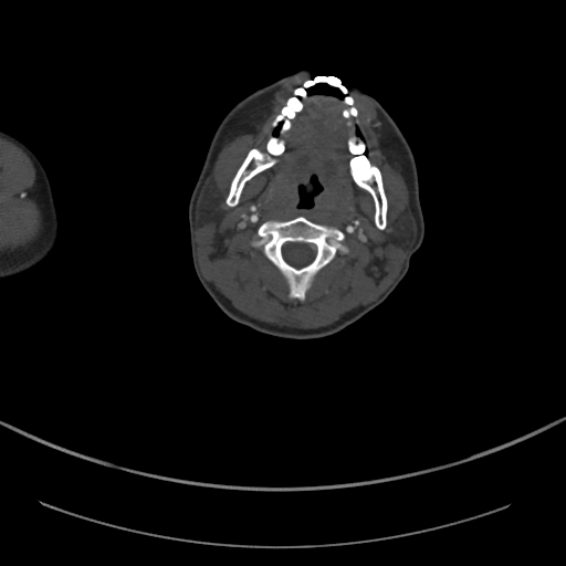 Brachiocephalic trunk pseudoaneurysm (Radiopaedia 70978-81191 Axial bone window 5).jpg