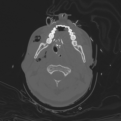 File:Brain contusions, internal carotid artery dissection and base of skull fracture (Radiopaedia 34089-35339 Axial bone window 26).png