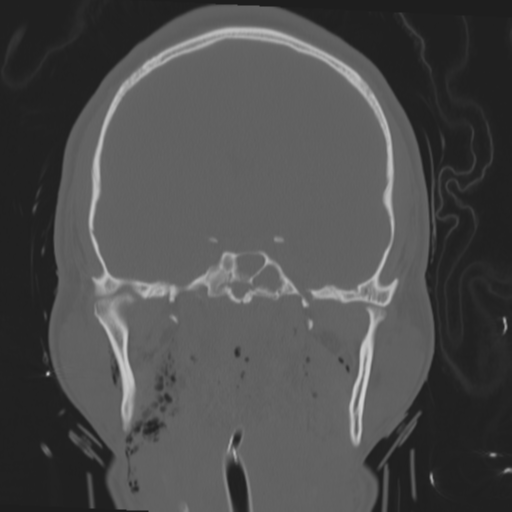 Brain contusions, internal carotid artery dissection and base of skull fracture (Radiopaedia 34089-35339 Coronal bone window 34).png