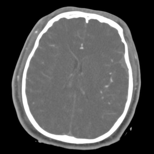 Brain contusions, internal carotid artery dissection and base of skull fracture (Radiopaedia 34089-35339 D 23).png