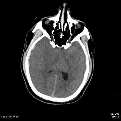 File:Brain death after motor vehicle collision (Radiopaedia 88470-105114 Axial non-contrast 15).jpg
