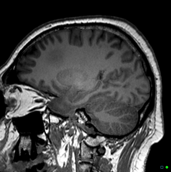 Brain death on MRI and CT angiography (Radiopaedia 42560-45689 Sagittal T1 1).jpg