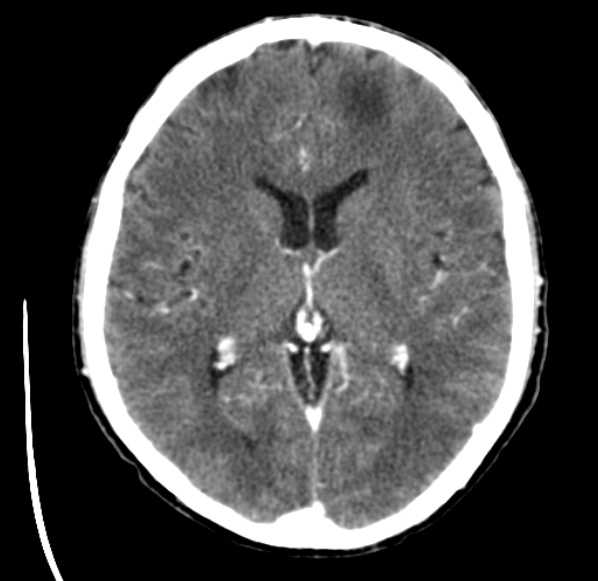 File:Brain metastases from lung cancer (Radiopaedia 24480-24781 Axial C+ delayed 32).jpg