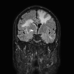 Brain metastases from lung cancer (Radiopaedia 83839-99028 Coronal FLAIR 35).jpg