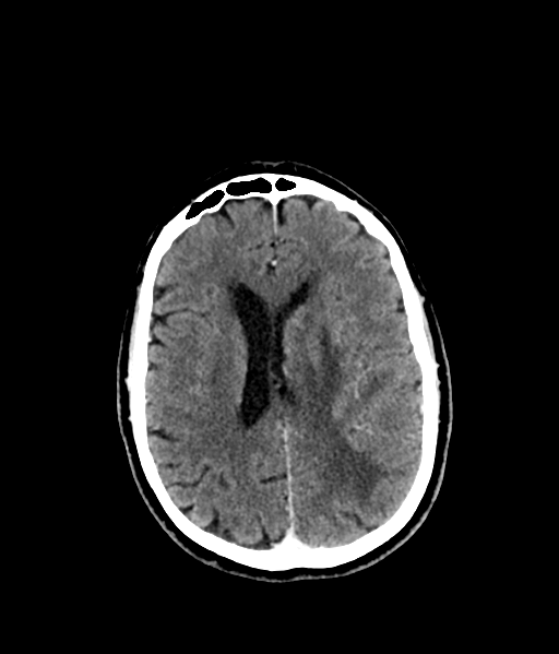 Brain metastasis (large cystic mass) (Radiopaedia 47497-52106 Axial C+ 39).png