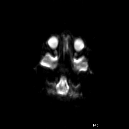 File:Brainstem ganglioglioma (Radiopaedia 10763-11224 Axial DWI 16).jpg