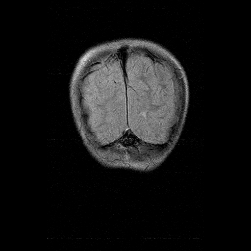 File:Brainstem ganglioglioma (Radiopaedia 10763-11224 Coronal FLAIR 2).jpg