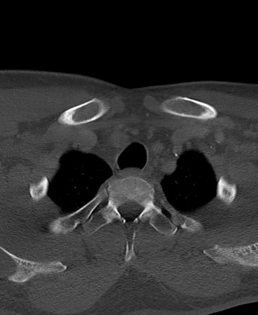 Branchial cleft cyst (Radiopaedia 31167-31875 Axial bone window 71).jpg