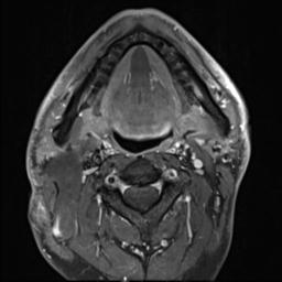 File:Branchial cleft cyst (Radiopaedia 31167-31876 Axial T1 C+ fat sat 16).jpg