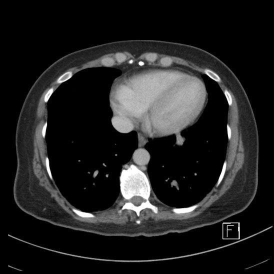 Breast metastases from renal cell cancer (Radiopaedia 79220-92225 C 1).jpg