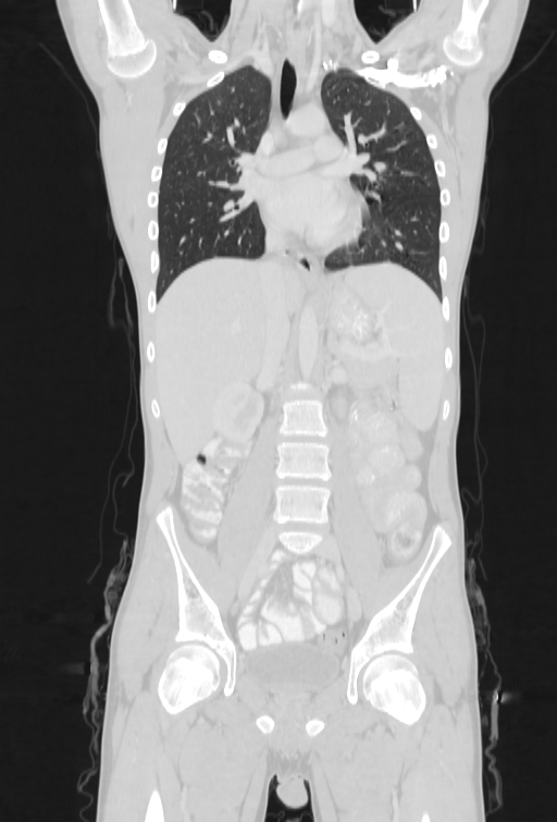 Bronchial carcinoid tumor (Radiopaedia 57187-64090 Coronal lung window 47).jpg