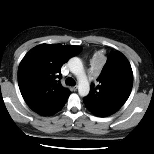 Bronchial carcinoid tumor (Radiopaedia 67377-76764 A 24).jpg
