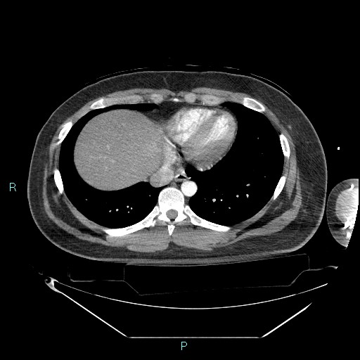 Bronchial carcinoid tumor (Radiopaedia 78272-90870 B 90).jpg