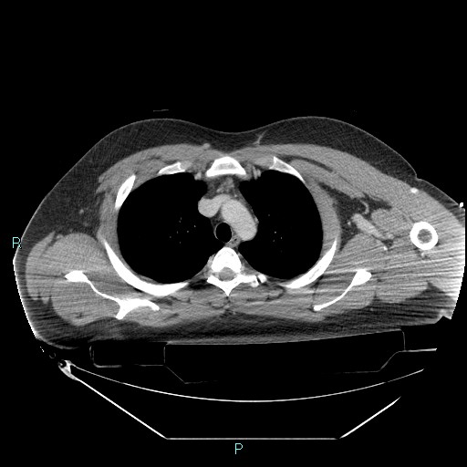 Bronchial carcinoid tumor (Radiopaedia 78272-90870 C 35).jpg