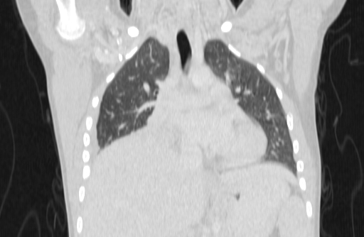 Bronchial mucoepidermoid carcinoma (Radiopaedia 57023-63895 Coronal lung window 5).jpg