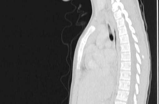 Bronchial mucoepidermoid carcinoma (Radiopaedia 57023-63895 Sagittal lung window 84).jpg