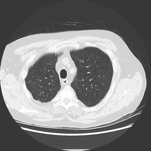 File:Bronchial stenosis - lung transplant (Radiopaedia 73133-83848 Axial lung window 16).jpg