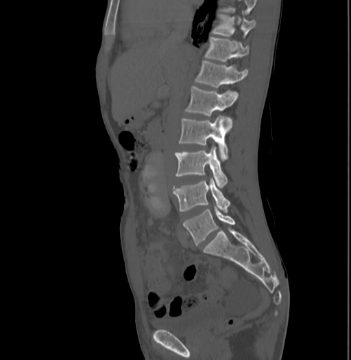 Bronchiectasis in Crohn disease (Radiopaedia 60311-67977 Sagittal bone window 107).jpg
