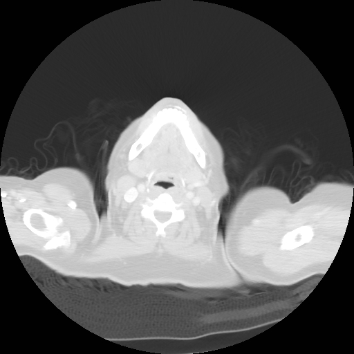 Bronchogenic carcinoma (Radiopaedia 73497-84262 Axial lung window 5).jpg