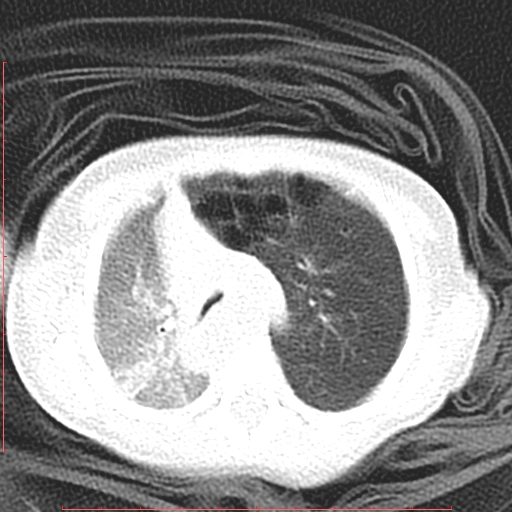 Bronchogenic cyst (Radiopaedia 78599-91409 Axial lung window 48).jpg