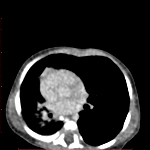 Bronchogenic cyst (Radiopaedia 78599-91409 B 111).jpg