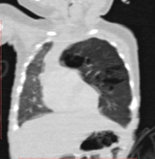 Bronchogenic cyst (Radiopaedia 78599-91409 Coronal lung window 73).jpg