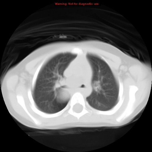 File:Bronchogenic cyst (Radiopaedia 9372-10063 Axial lung window 6).jpg