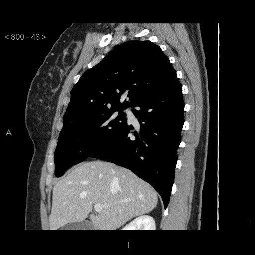Bronchogenic cyst - posterior mediastinal (Radiopaedia 43885-47364 B 31).jpg