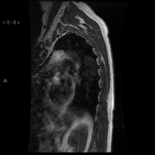 File:Bronchogenic cyst - posterior mediastinal (Radiopaedia 43885-47365 Sagittal T1 6).jpg