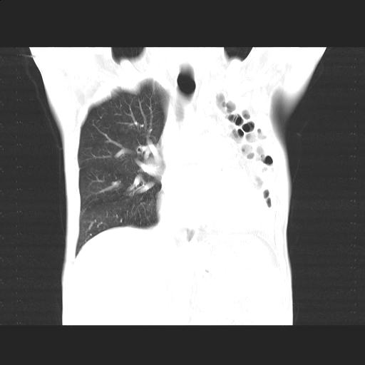 File:Bronchopleural fistula secondary to tuberculosis (Radiopaedia 20415-20322 Coronal lung window 9).jpg