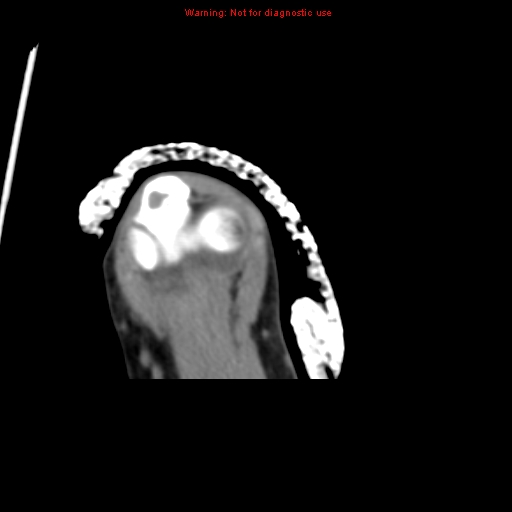File:Brown tumor (Radiopaedia 12460-12694 Axial non-contrast 133).jpg