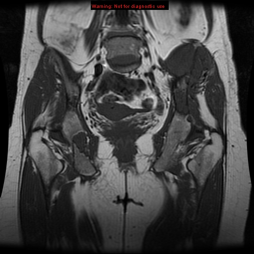 File:Brown tumors (Radiopaedia 9666-10290 Coronal T1 17).jpg