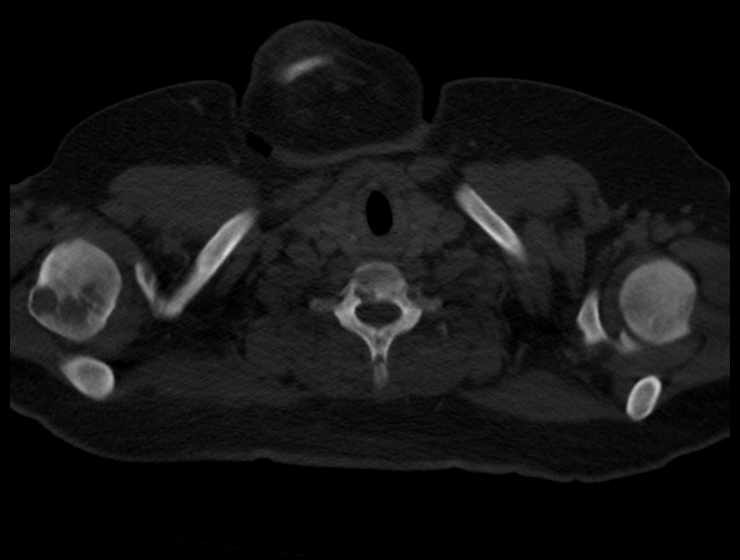 Brown tumors compressing the spinal cord (Radiopaedia 68442-77988 Axial bone window 1).jpg