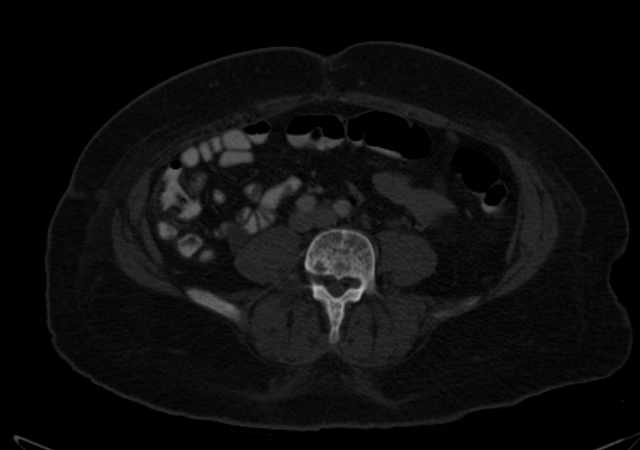 Brown tumors compressing the spinal cord (Radiopaedia 68442-77988 G 78).jpg